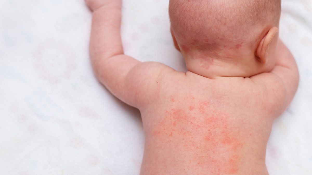 Penyebab ruam pada anak - Medikacare