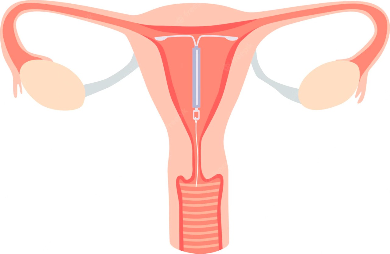 5 Hal yang harus dilakukan agar tidak hamil ketika menggunakan IUD - Medikacare