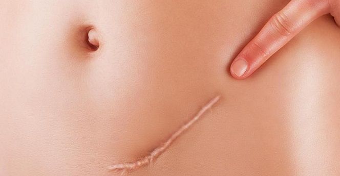 5 Obat Penyembuh Luka Operasi Terbaik untuk Pemulihan Cepat