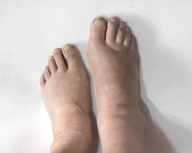 Apakah Varises pada Ibu Hamil masih bisa disembuhkan ? - Medikacare