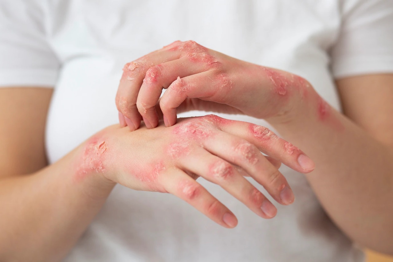 Herpes - Medikacare