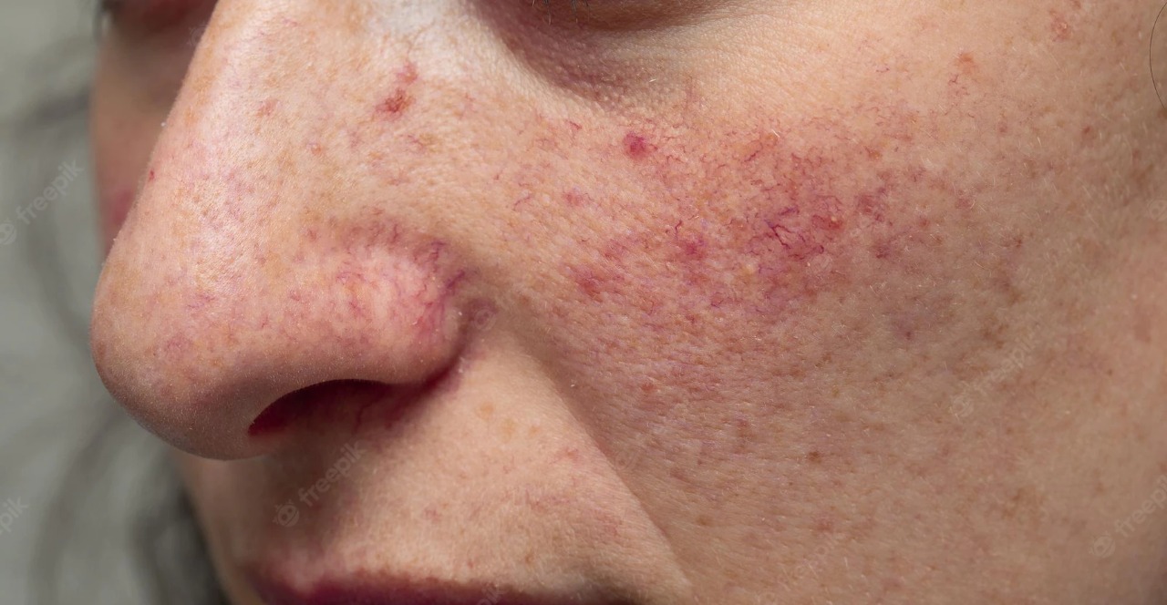 Kenali apa itu Rosacea ? - Medikacare