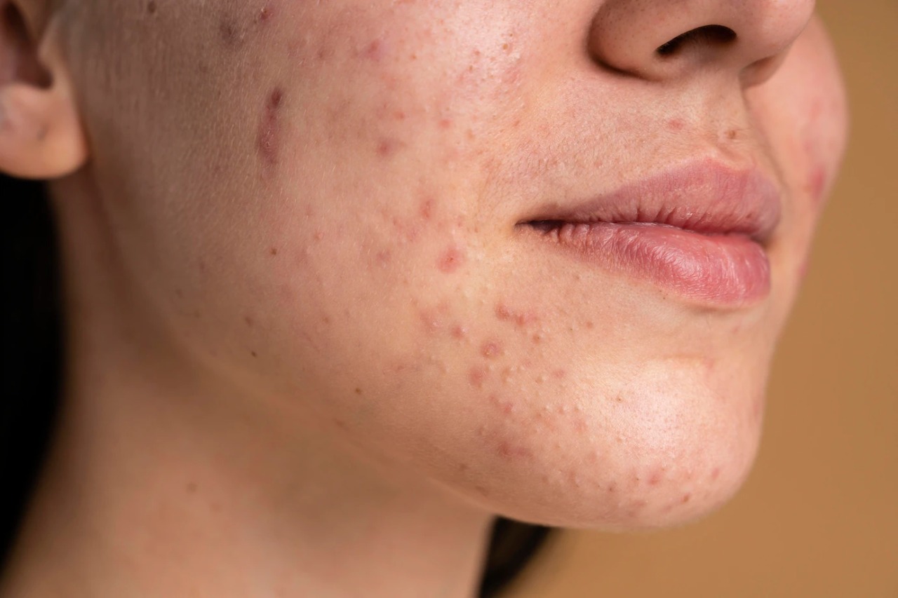 Kenali kandungan dari serum penghilang bekas jerawat - Medikacare