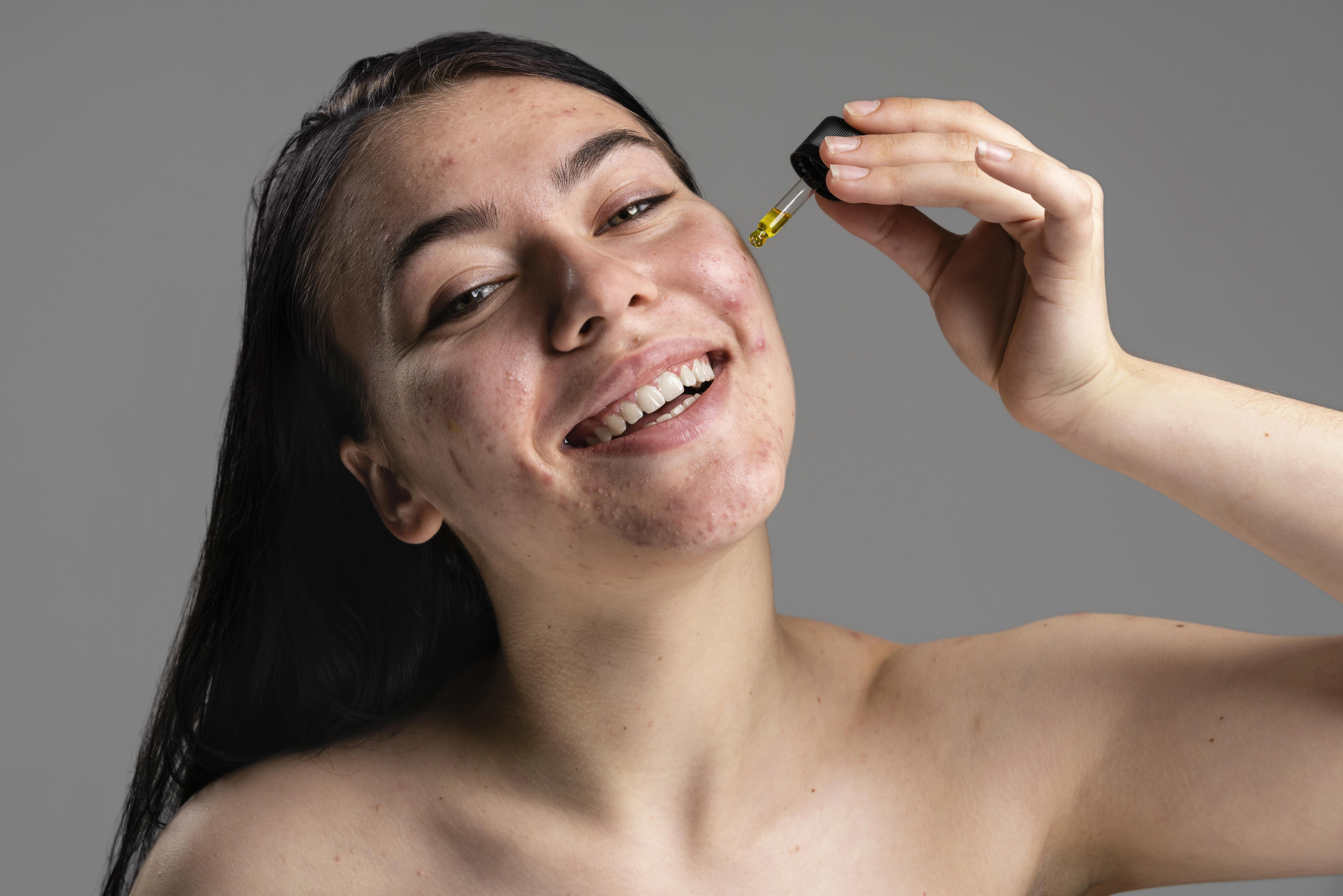 Serum penghilang bekas jerawat - Medikacare