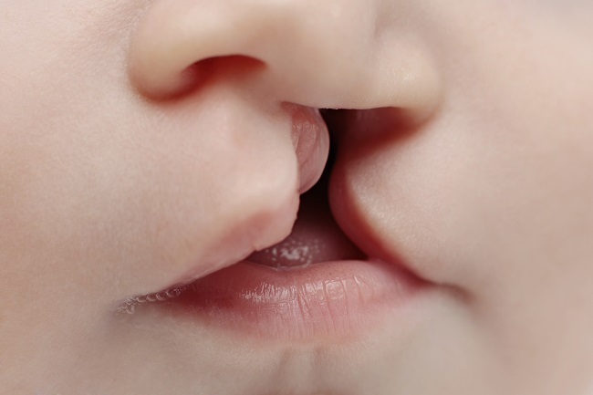 Kenali mencegah bibir sumbing selama dalam kandungan - Medikacare