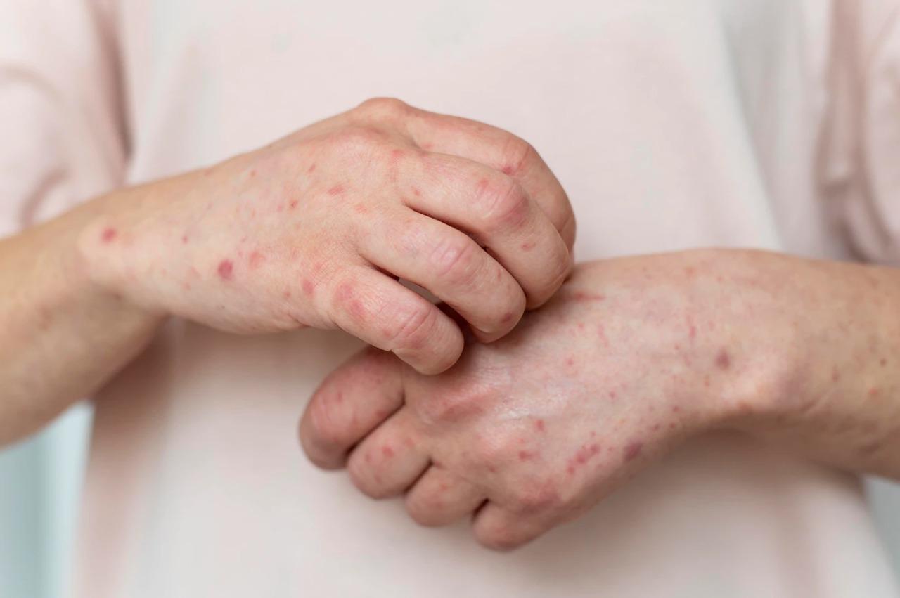 Tips mengobati Herpes dengan cara alami - Medikacare