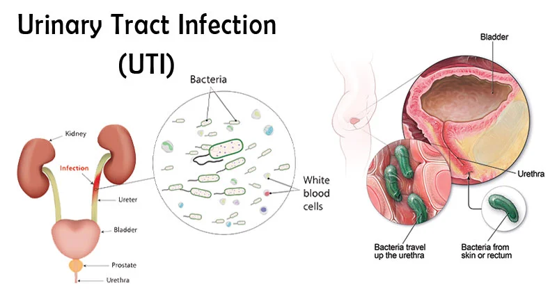 Urinary Tract Infection: Memahami, Mencegah, dan Mengatasi dengan Bijak - MedikaCare