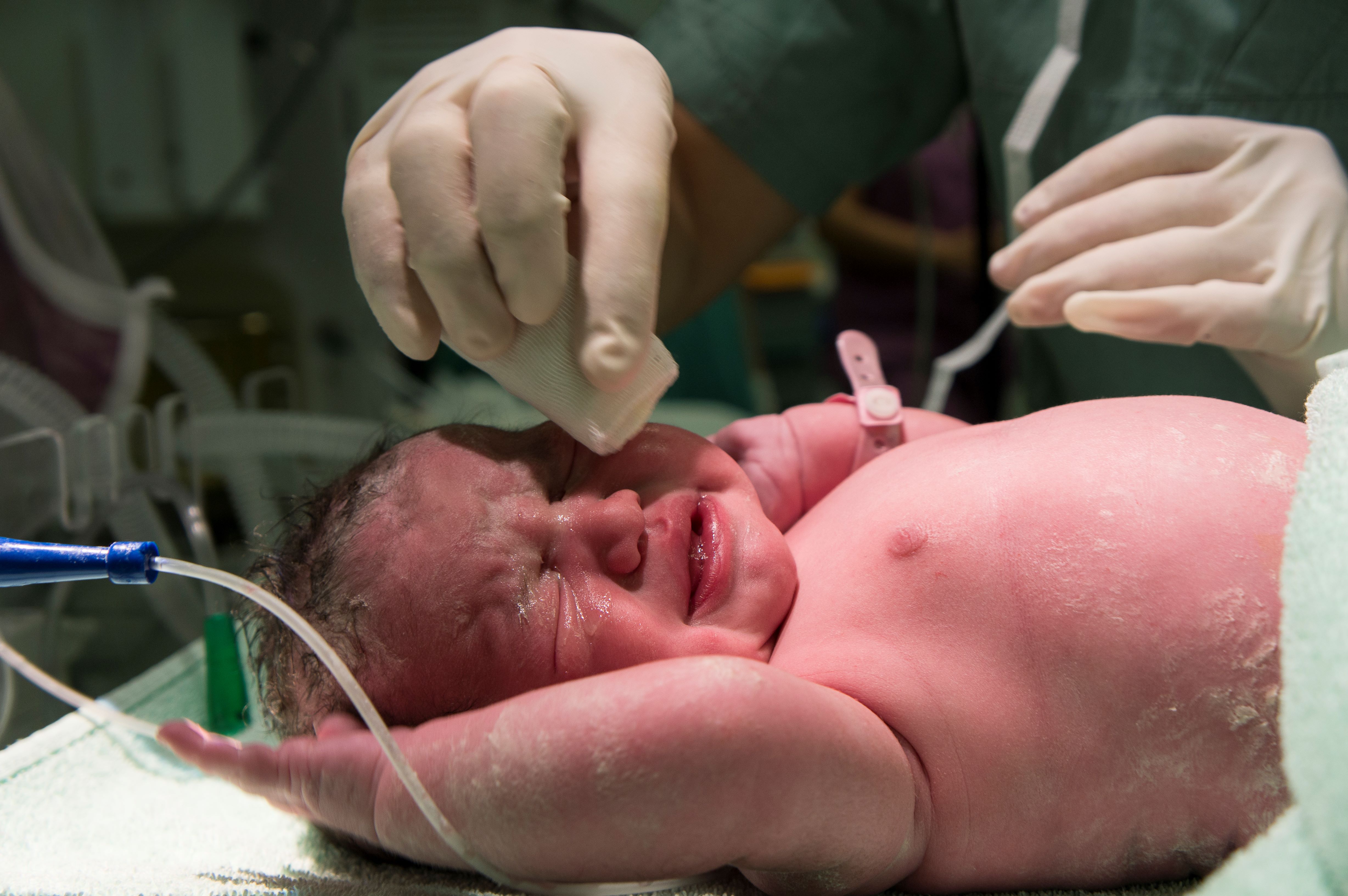 Benarkah bayi yang dilahirkan melalui caesar memiliki sistem kekebalan tubuh yang lemah - Medikacare