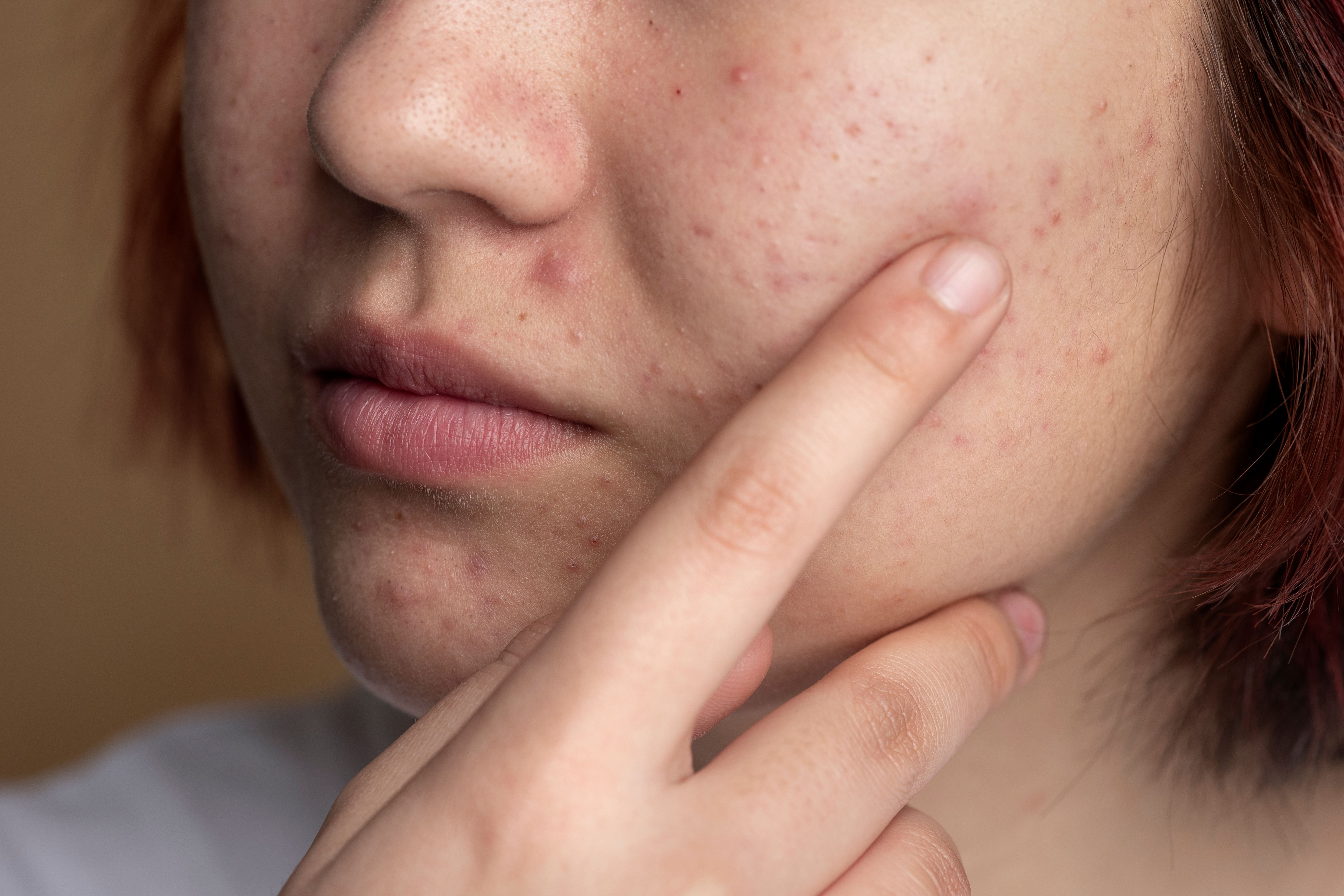 Masker alami untuk mengatasi bruntusan - Medikacare