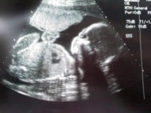 Perkembangan kehamilan di usia 23 minggu - Medikacare