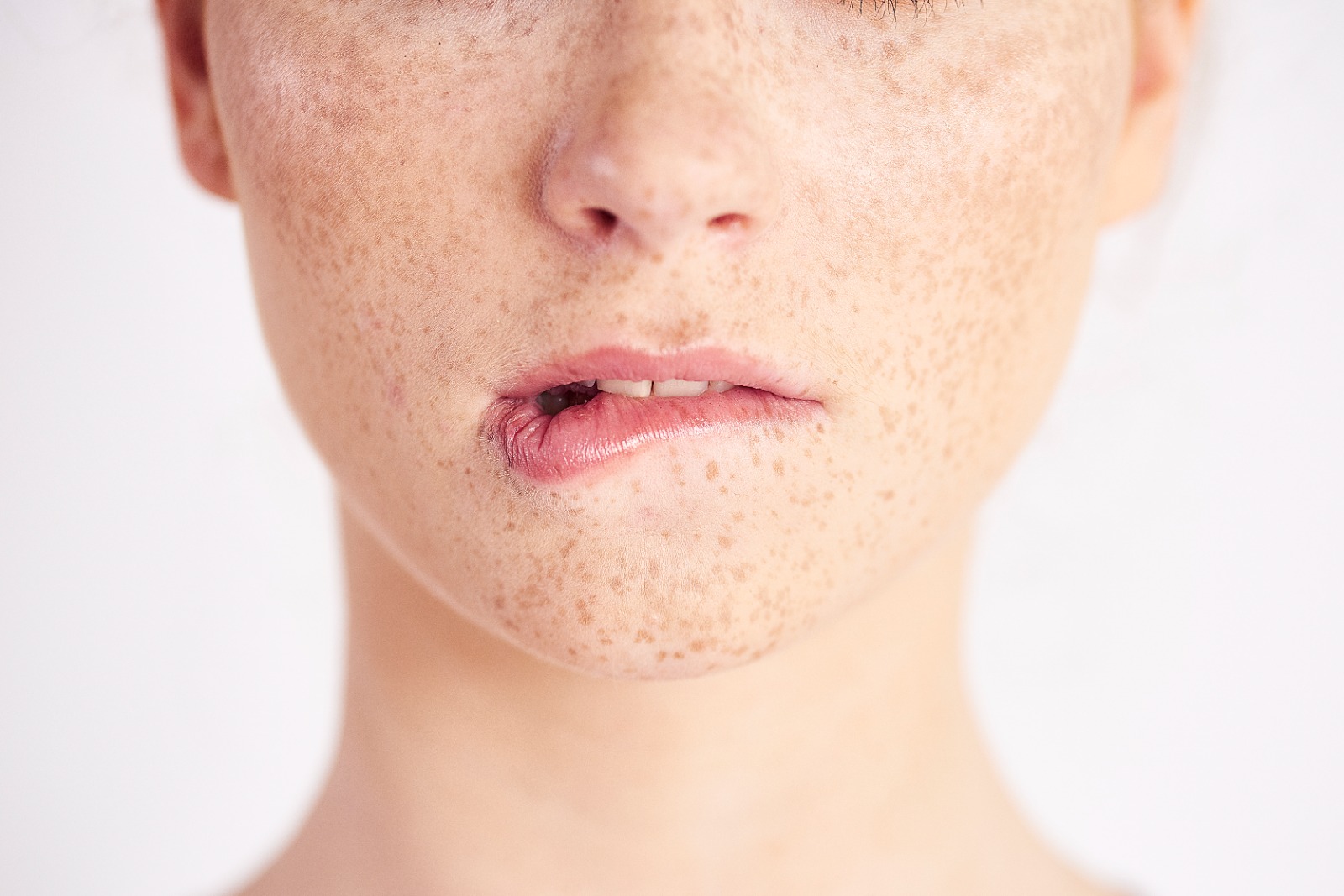 Melasma - Medikacare