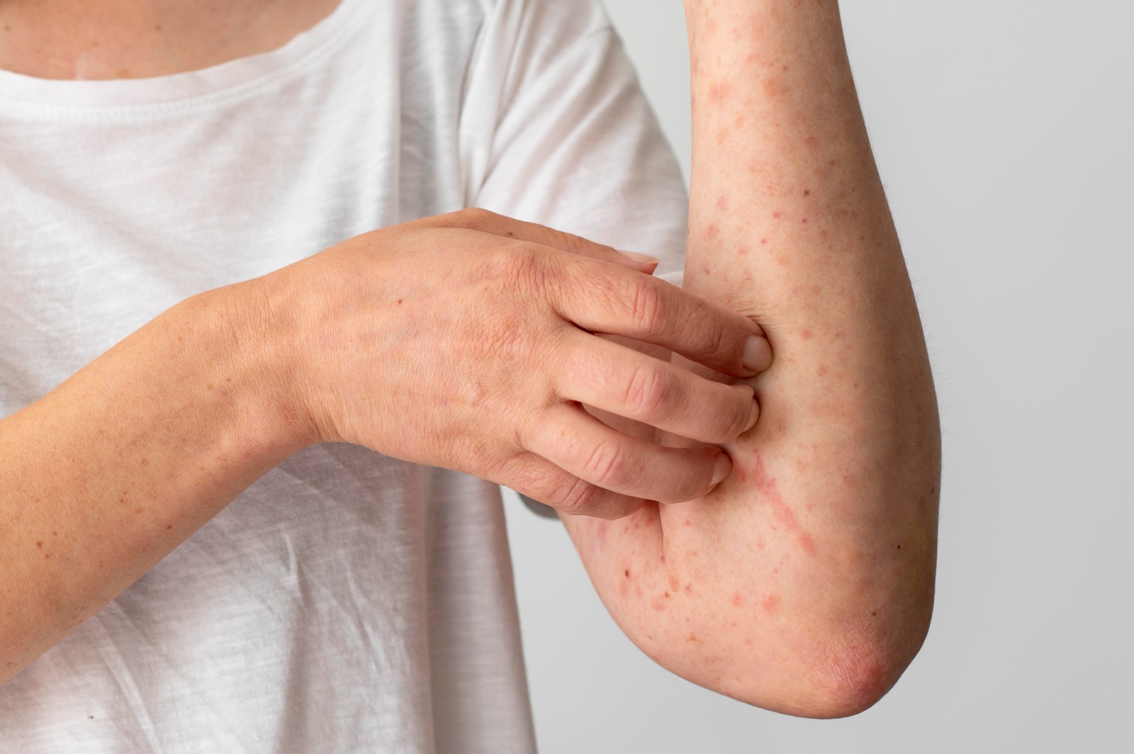 Psoriasis - Medikacare