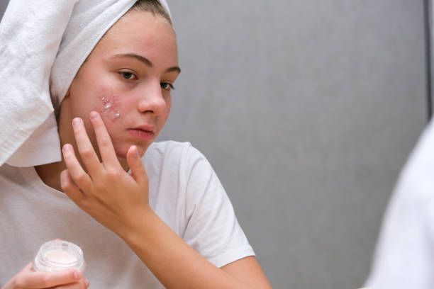 Rekomendasi 6 Acne Spot Treatment Terbaik untuk Memudarkan Bekas Jerawat