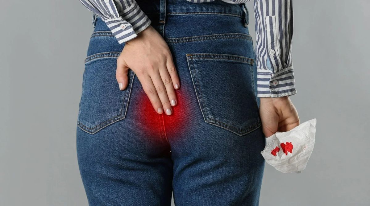 Sering BAB Berdarah? Ini 6 Obat Wasir Herbal untuk Meredakan Ambeien