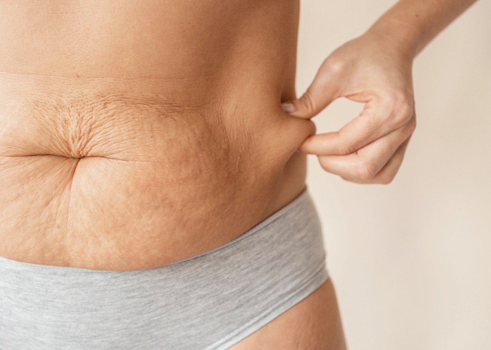 Jenis-jenis Stretch Mark - Medikacare